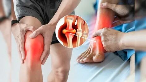 Područja kože pogodna za nanošenje Icexin gela (koljena, laktovi, donji dio leđa)