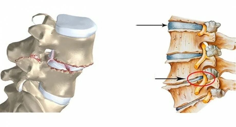 normalni i oštećeni spinalni disk