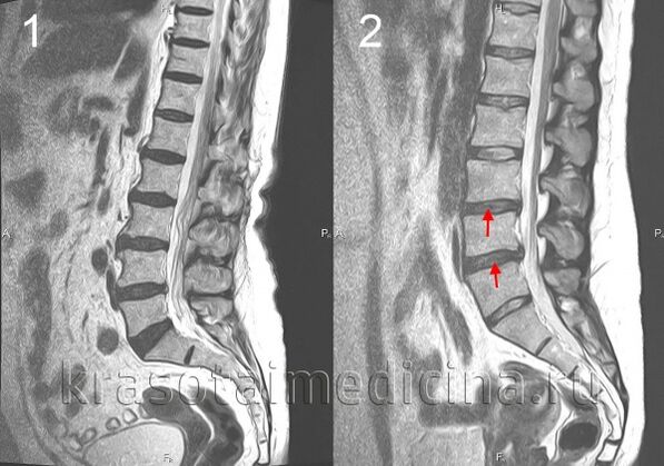 osteohondroza kralježnice